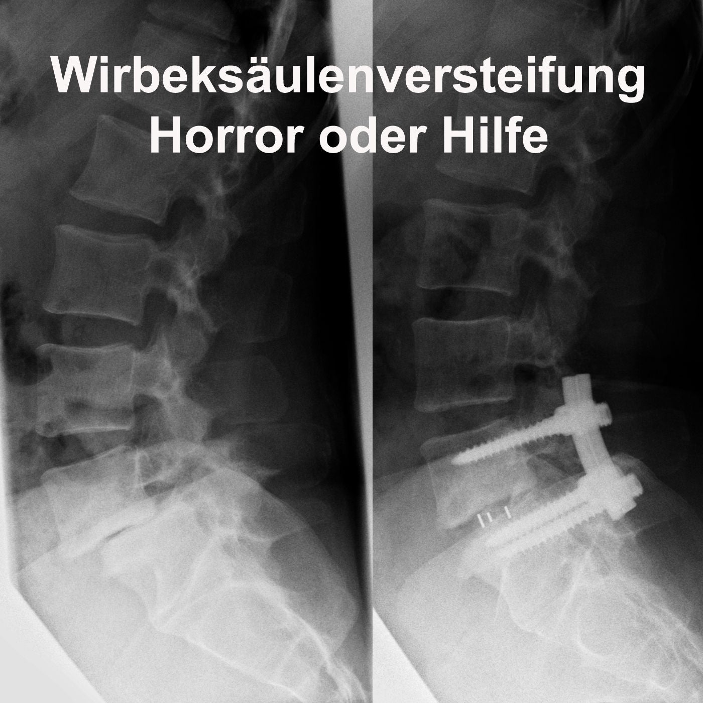 Wirbelsäulenversteifung - Horror oder Hilfe
