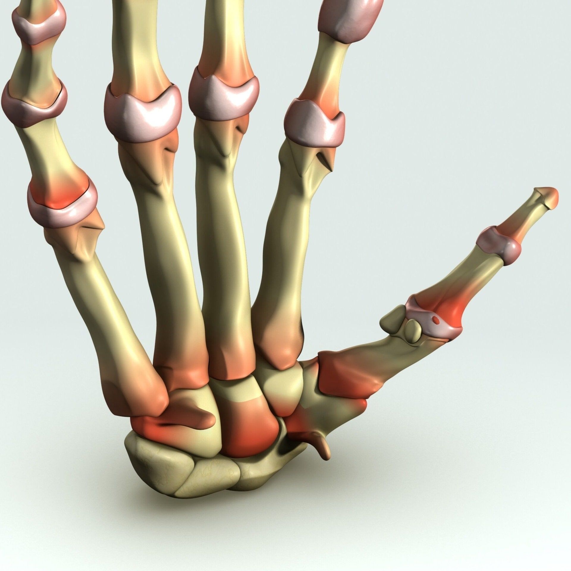 Arthrose und Arthritis/Rheuma – Was ist der Unterschied?