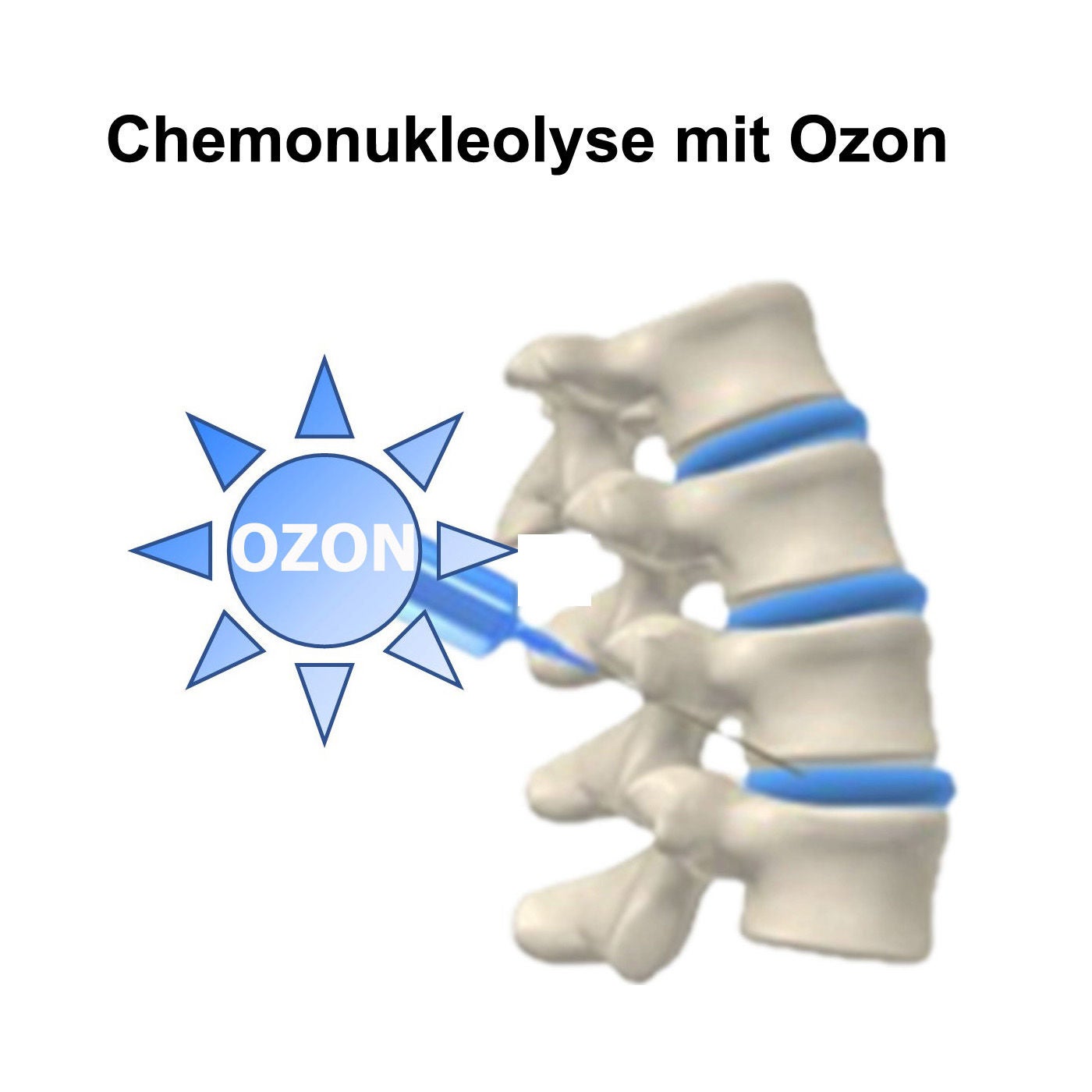 Die Ozontherapie des Bandscheibenvorfalls
