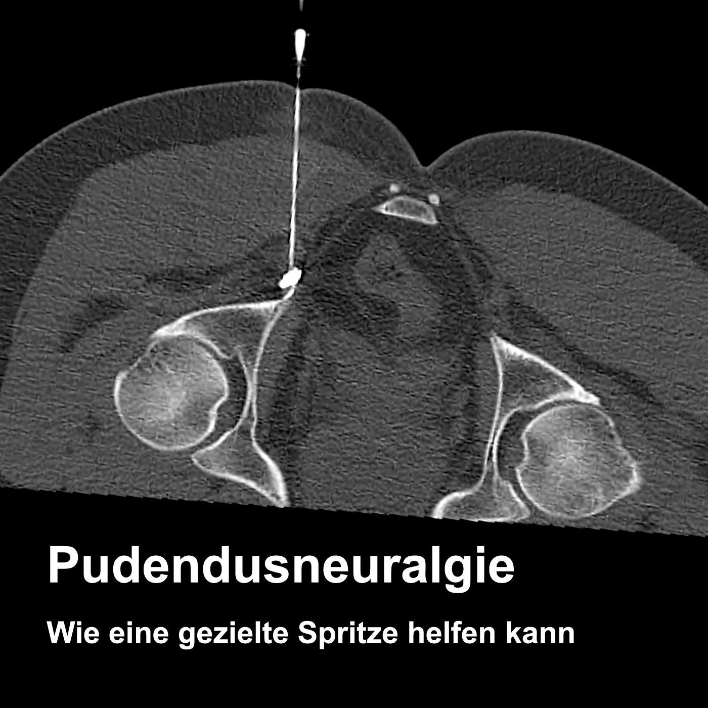Pudendusneuralgie – Wenn der Nerv im Becken schmerzt