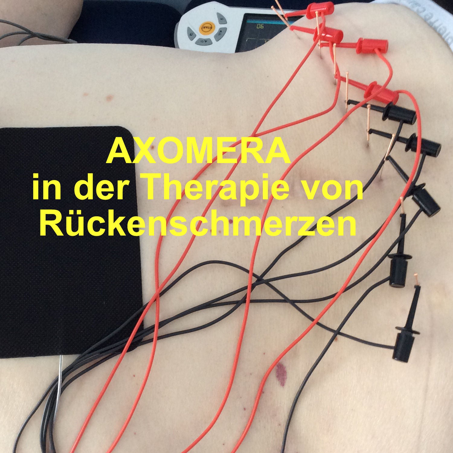 Bioelektrische Stimulationsthetapie - Wie kann Axomera bei Rückenschmerzen helfen