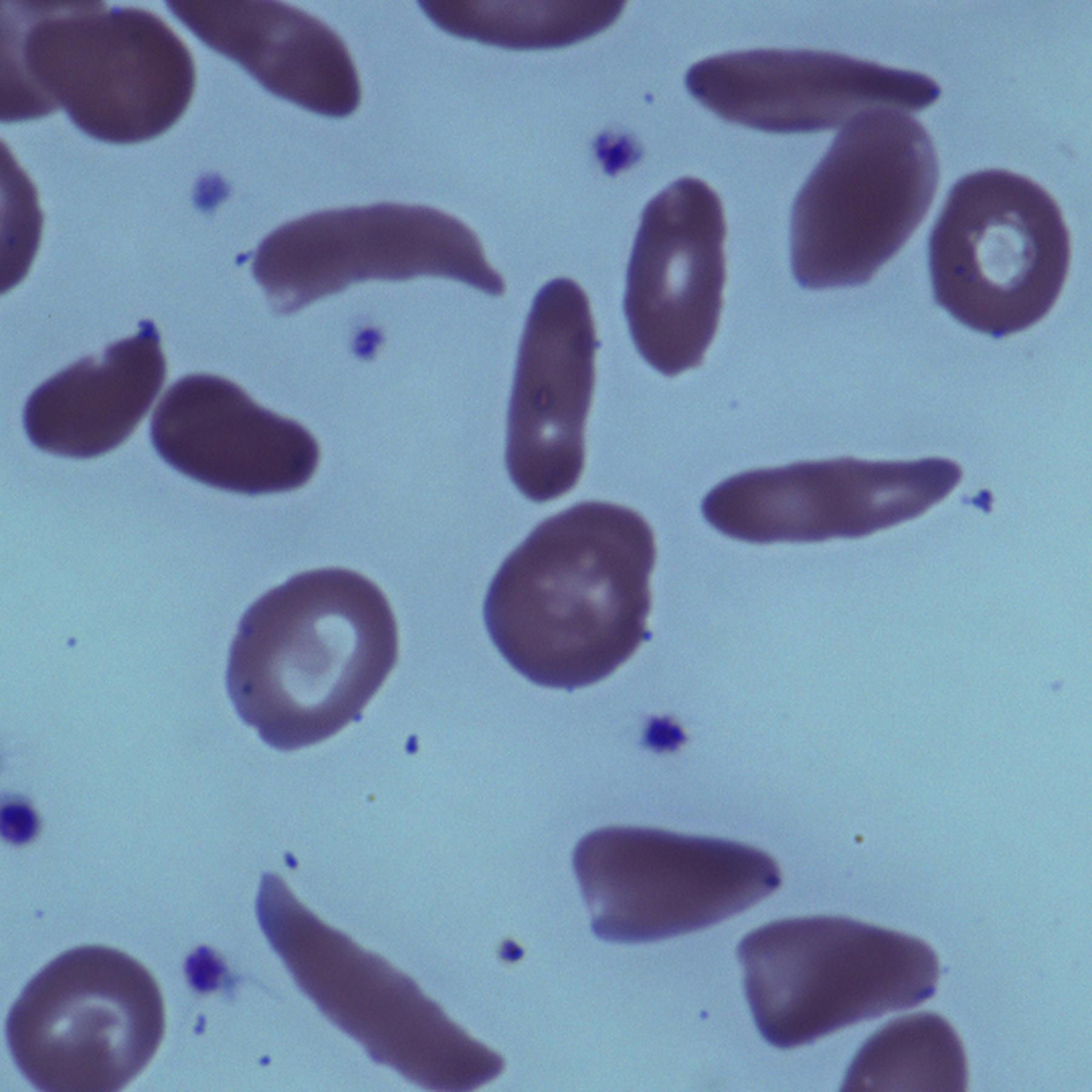 Genschere CRISPR/Cas am Menschen - Was bringt die Zulassung einer Gentherapie?