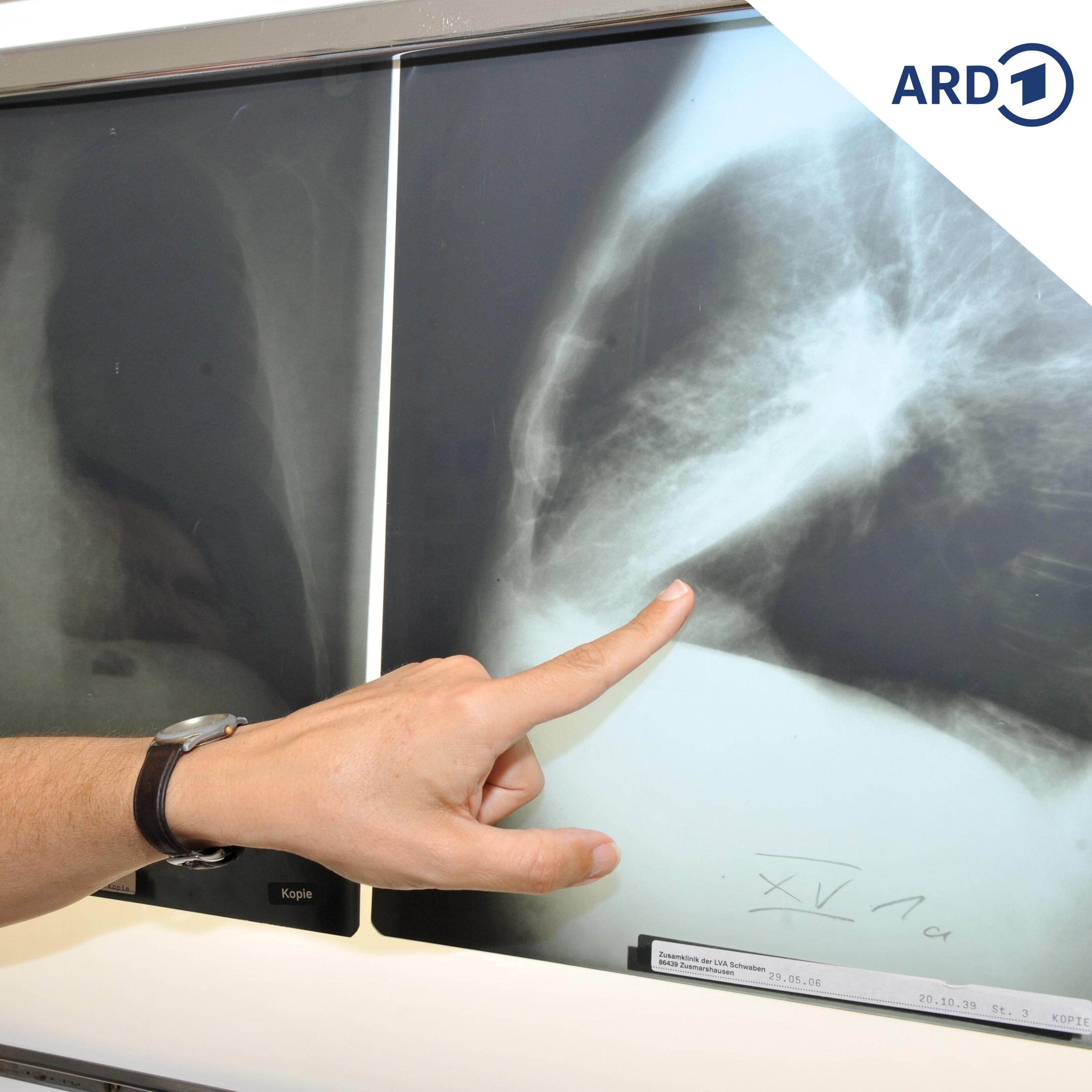Ab April: Kostenlose Krebsvorsorge für Starkraucher
