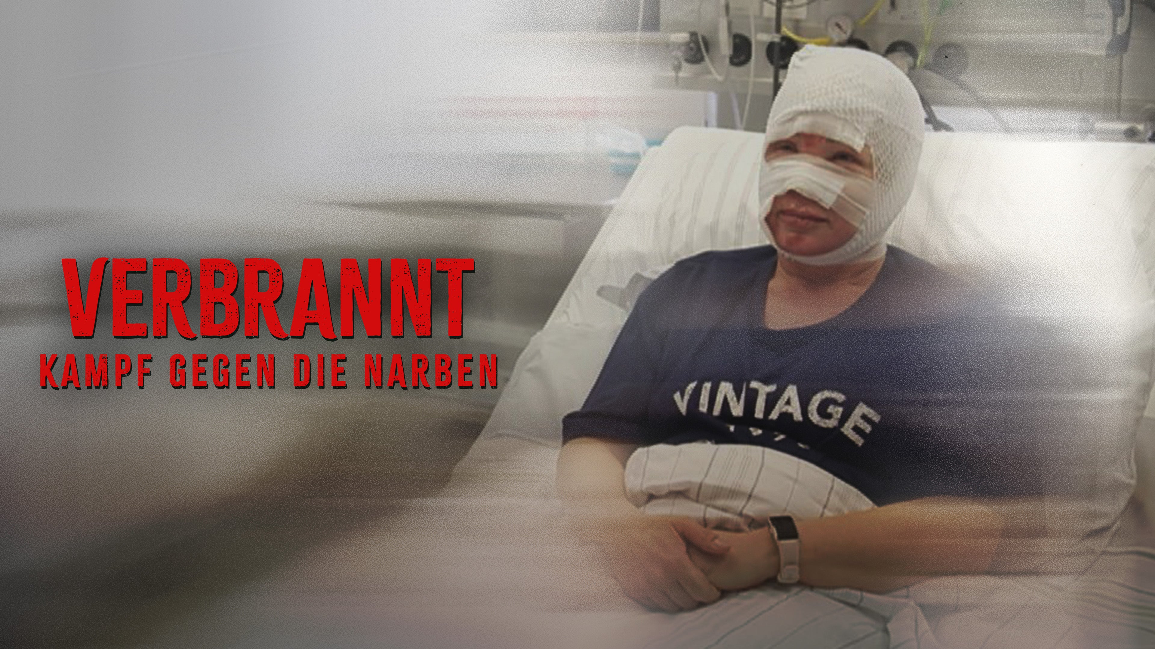 VERBRANNT - Kampf gegen die Narben!