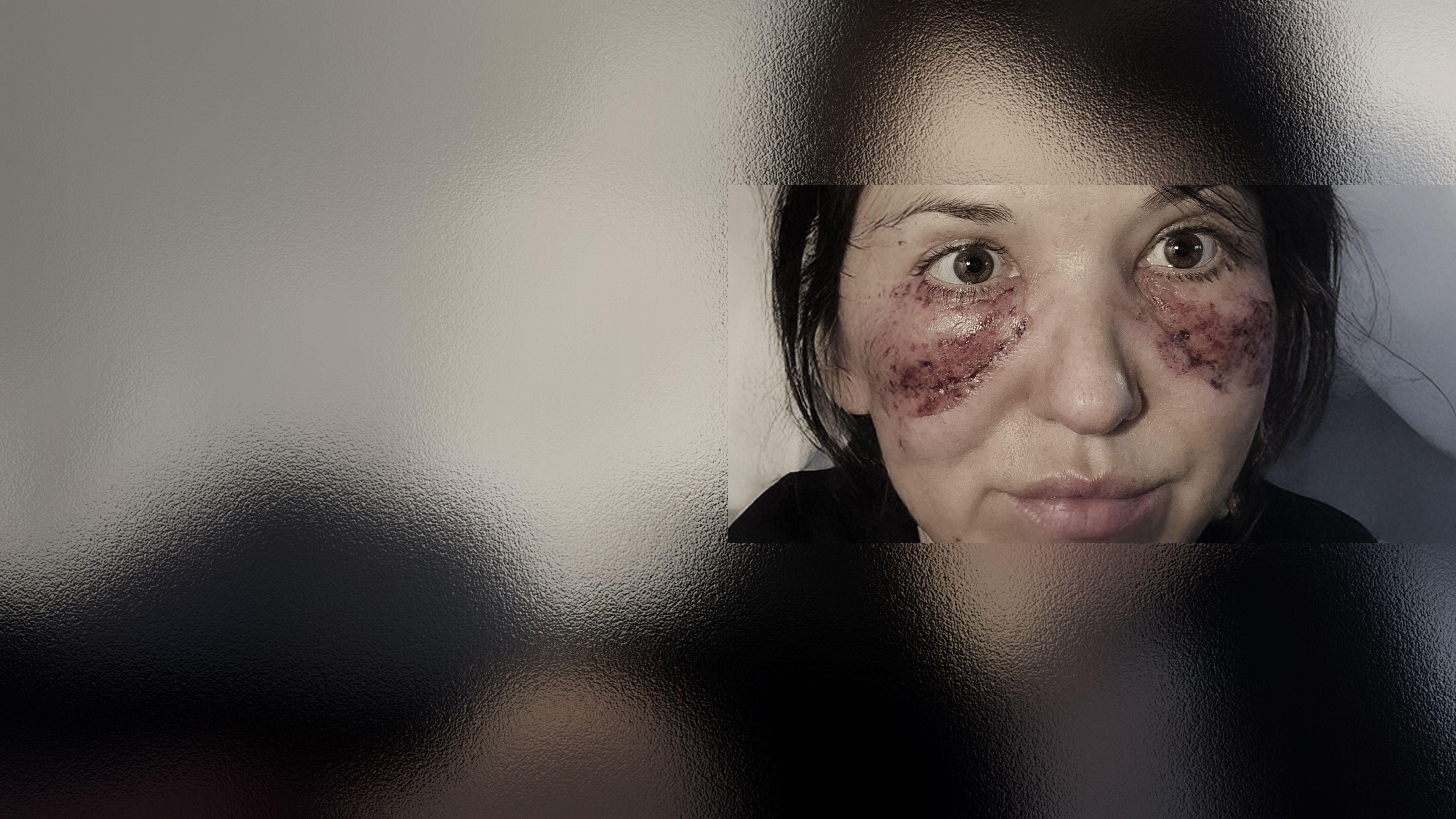 Augen auf, Albtraum an! Schönheits-OPs außer Kontrolle