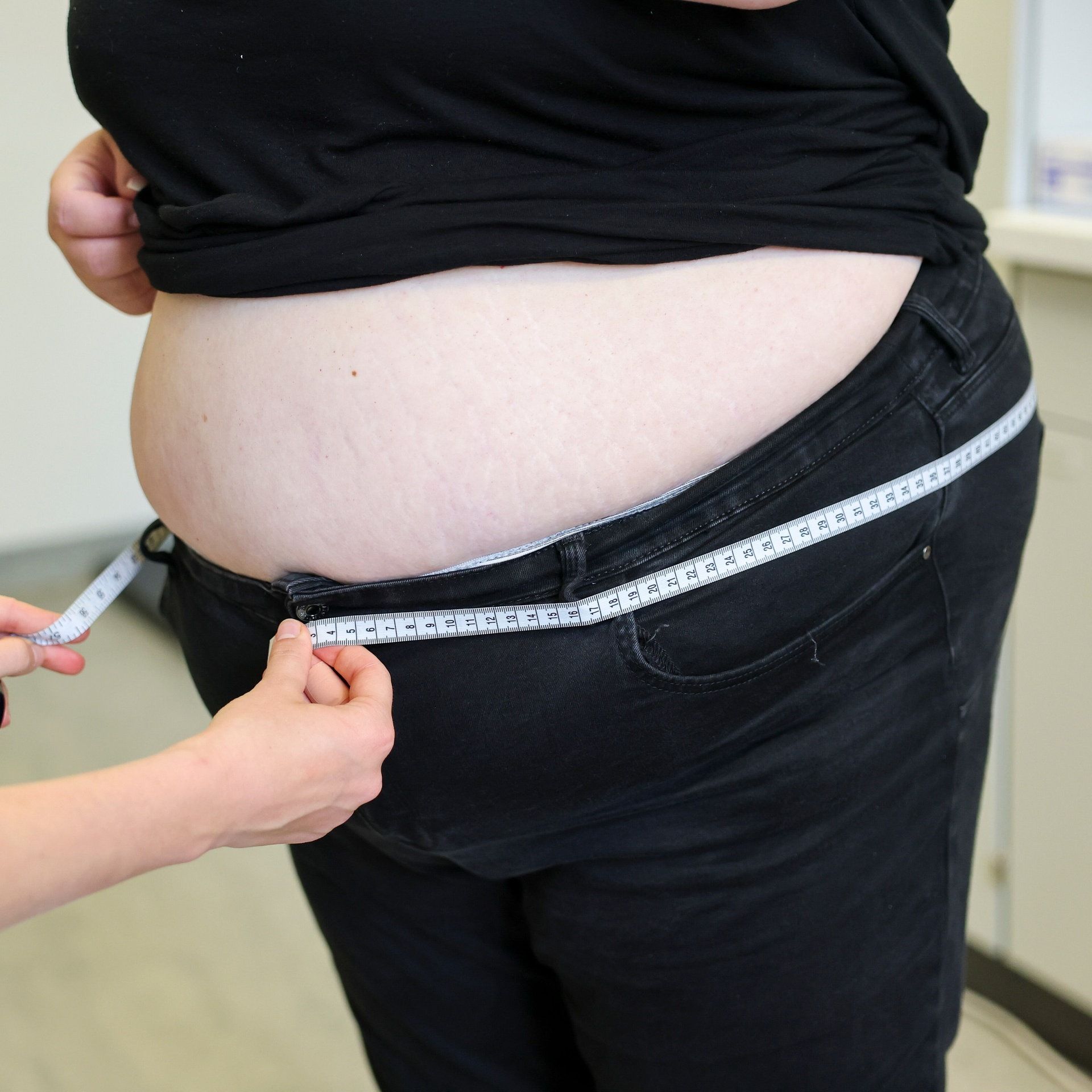 Adipositas: Studie entwickelt KI-Prognose über Behandlungserfolg