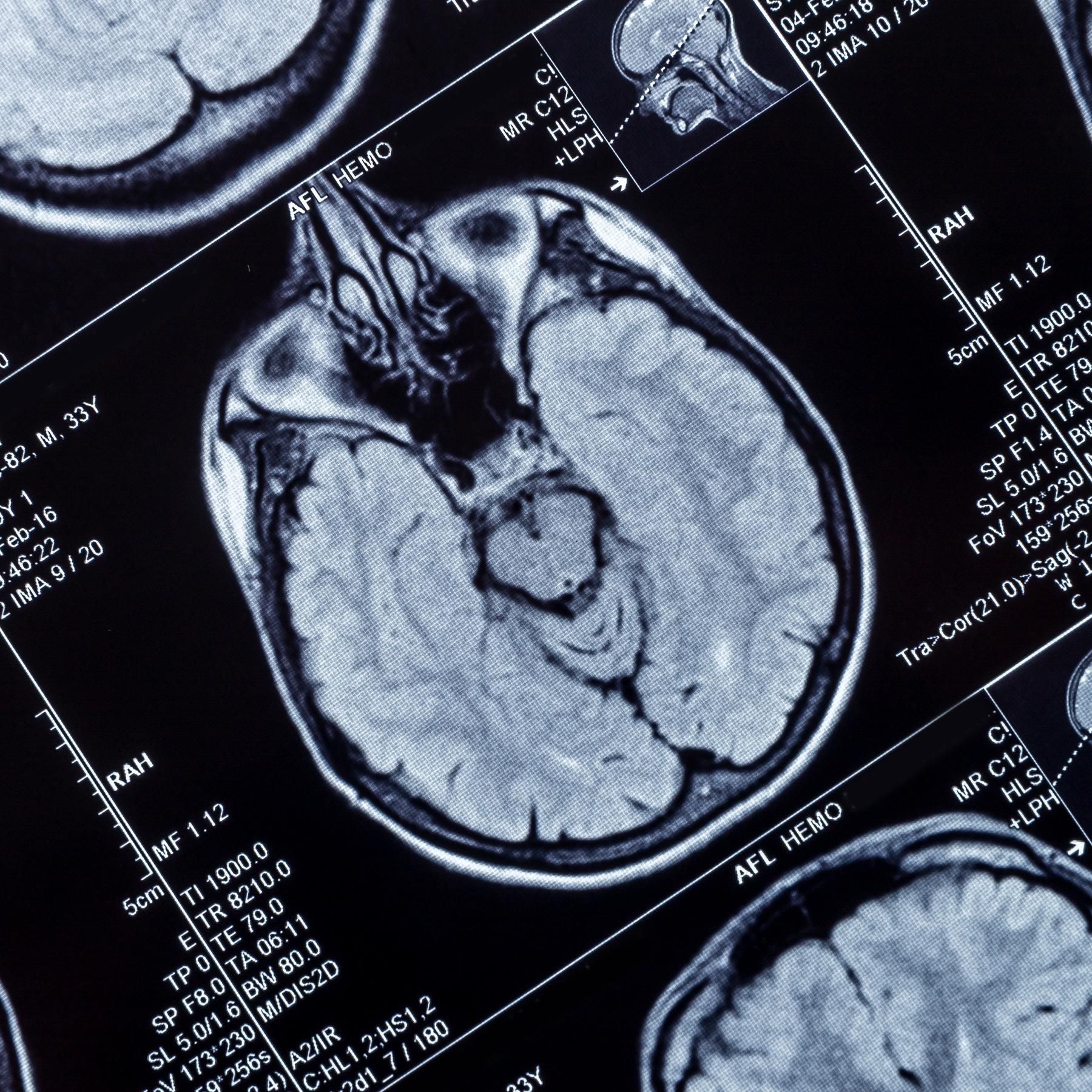 Fälschungsverdacht bei Alzheimerforschung, Reise zum Mars, Sterne im August, Quaggamuschel im Bodensee