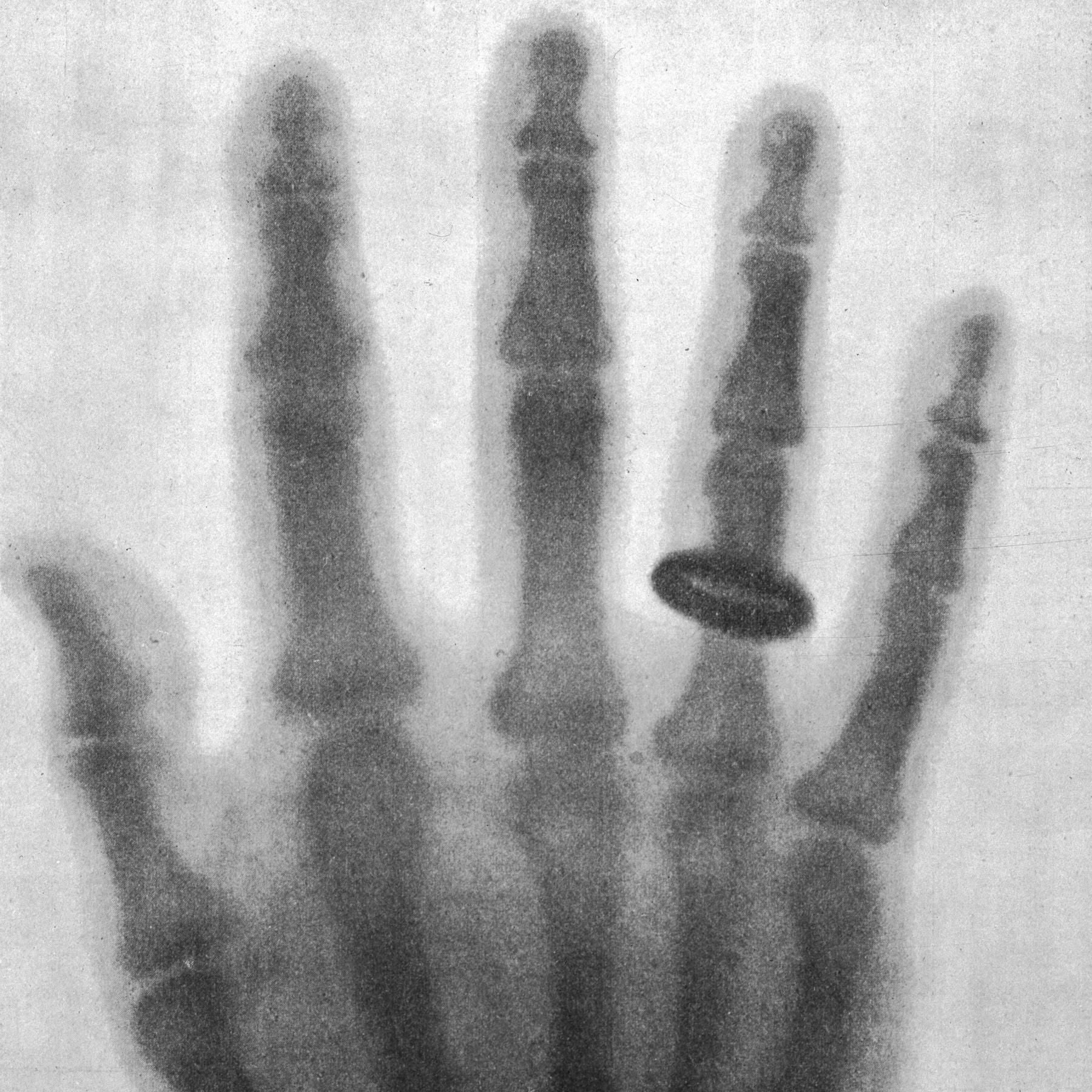 Diagnose durch Röntgen - Eine medizinische Revolution